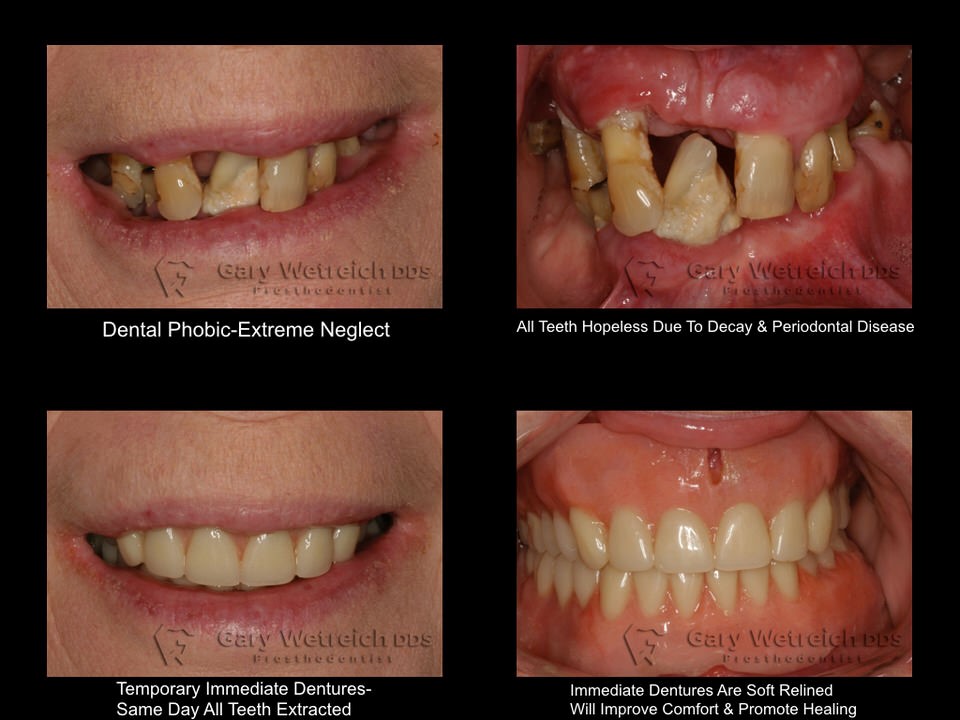 Extractions And Immediate Dentures Stamford CT 6920
